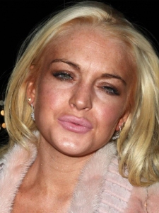 Lindsay-Lohan-lip-injections